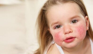 Anne ya da babasında alerji olan çocuklar risk altında