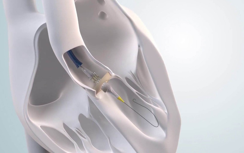 Tavi Yöntemi Ne Zaman Tercih Edilmektedir?